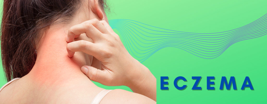 Eczema OVERVIEW​ ,SYMPTOMS​, CAUSES​, TREATMENT
