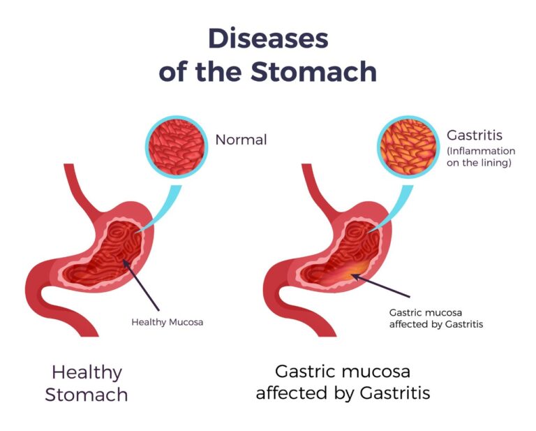Gastritis Problems and Prevention